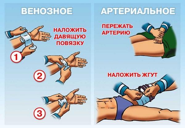 остановка кровотечения