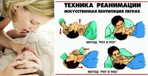 как правильно реанимировать человека